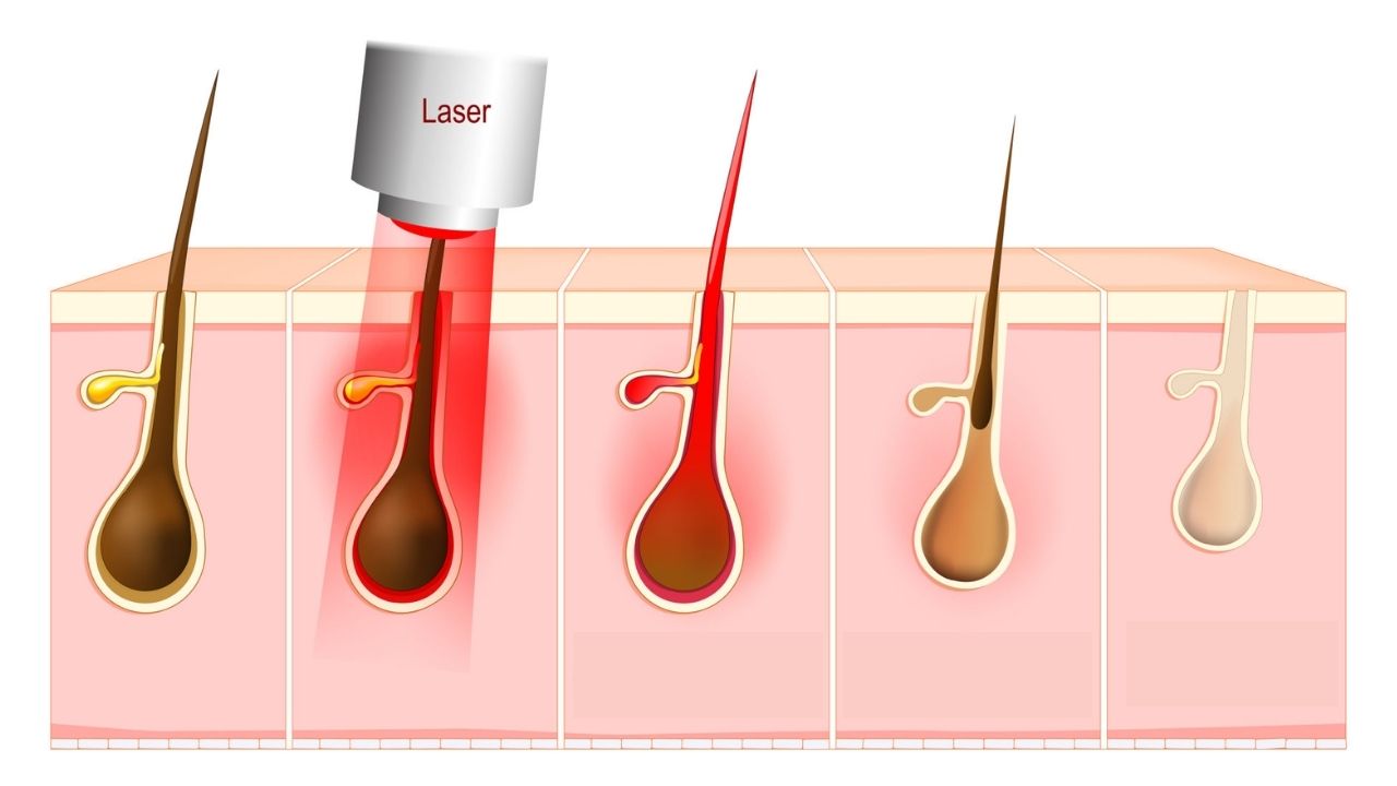 Principais métodos de depilação a laser
