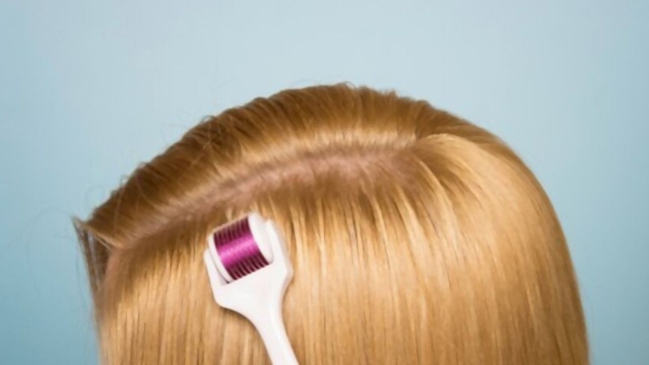 Microagulhamento capilar: o que é, antes e depois e valor