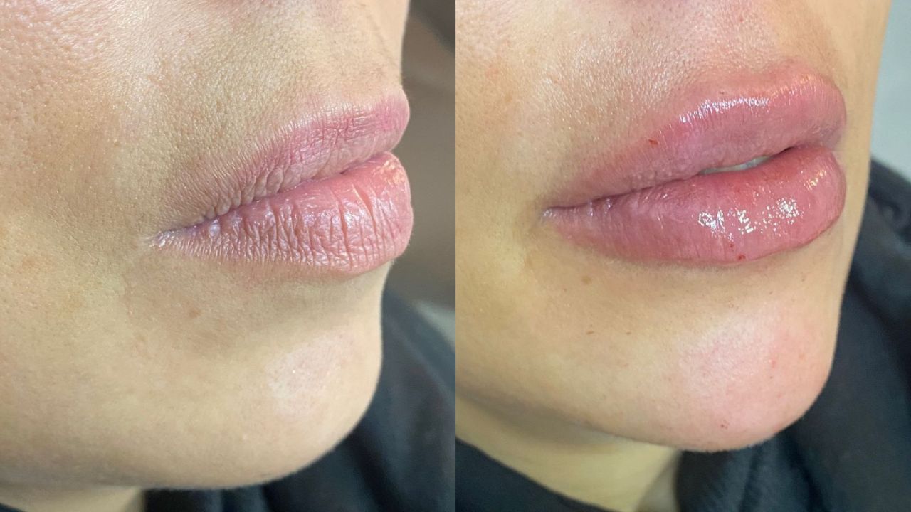 preenchimento labial com ácido hialurônico