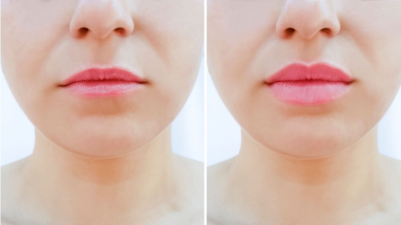 antes e depois preenchimento labial