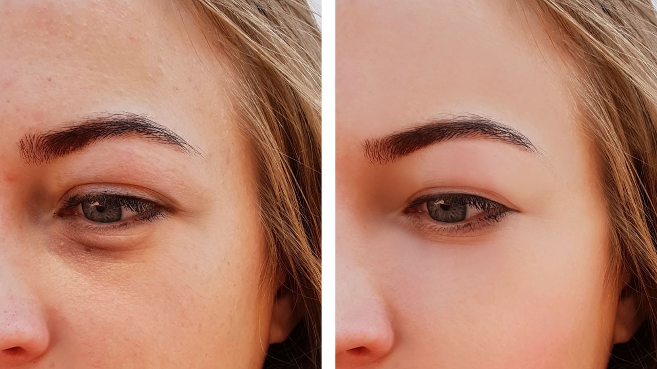 skinbooster olheiras antes e depois