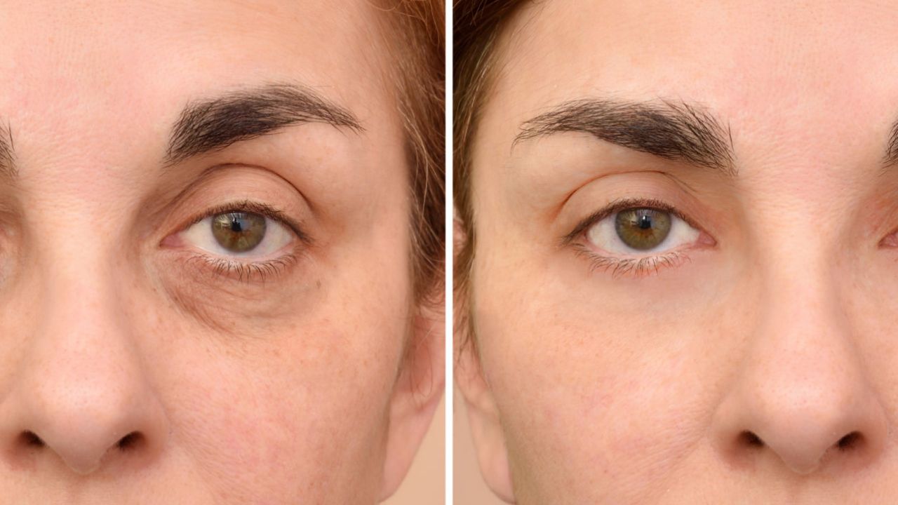 preenchimento de olheiras com ácido hialurônico antes e depois
