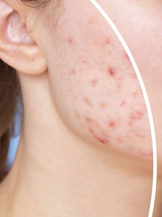 Como tirar manchas de acne? Descubra dicas Infalíveis