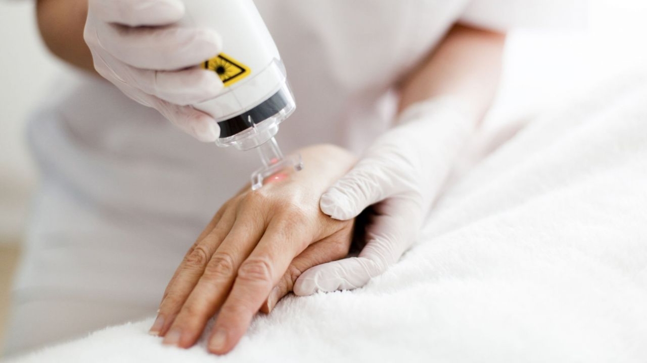 Dermatologista realizando a aplicação do laser co2 em mão de paciente