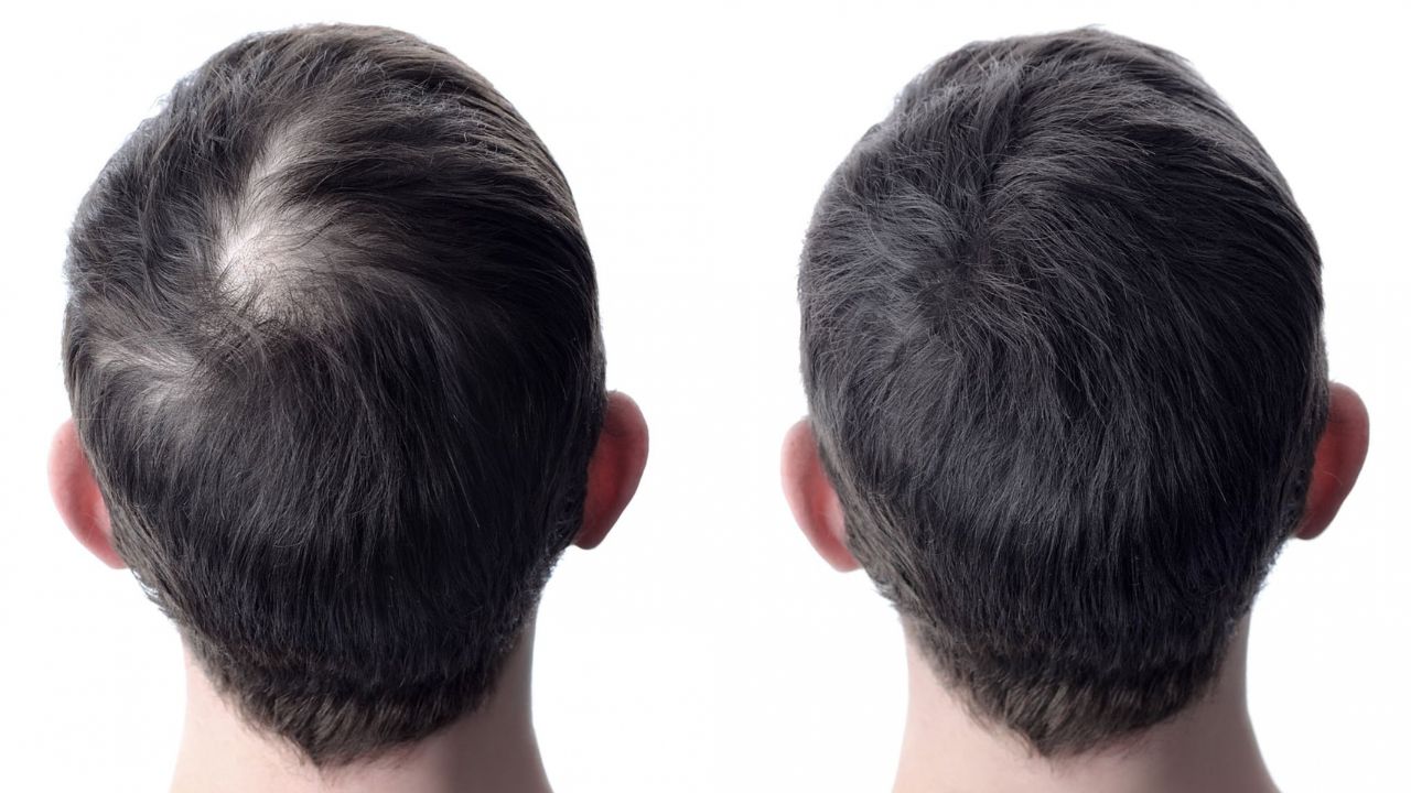 mesoterapia capilar antes e depois mesoterapia capilar antes e depois