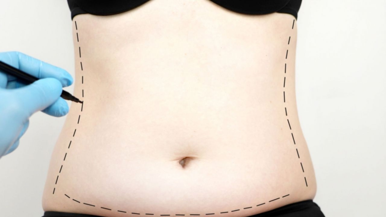 Marcação sobre cintura e barriga de paciente prestes a ser submetido a mini lipoescultura