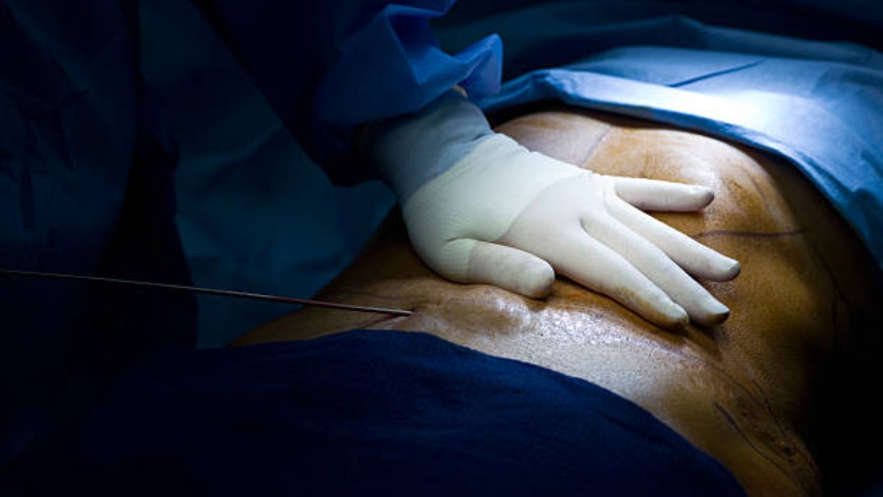 qual o melhor exercício para fechar diástase Abdominoplastia sendo realizada para minimizar a diástase