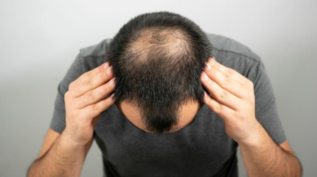 homem com alopecia androgenética mostrando seu cabelo que caiu
