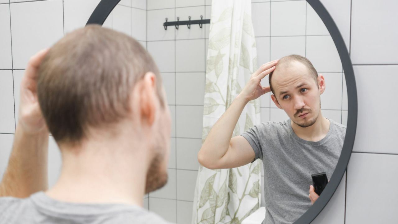 homem se olhando no espelho e vendo sintomas de alopecia androgenetica