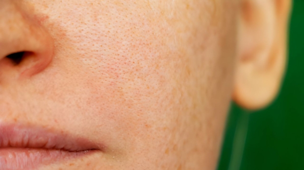 o que são poros dilatados? rosto de mulher com muitos poros
